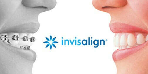 Invisalign