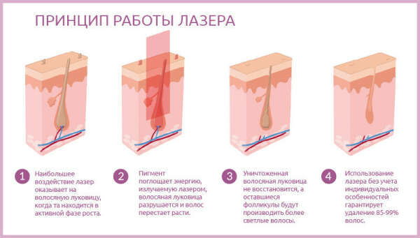 Лазерная эпиляция