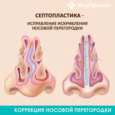 Исправить нос